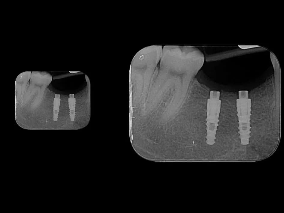 Radiografia de implantes dentários