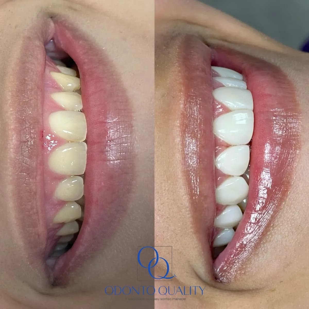 Facetas dentárias, detalhe do sorriso