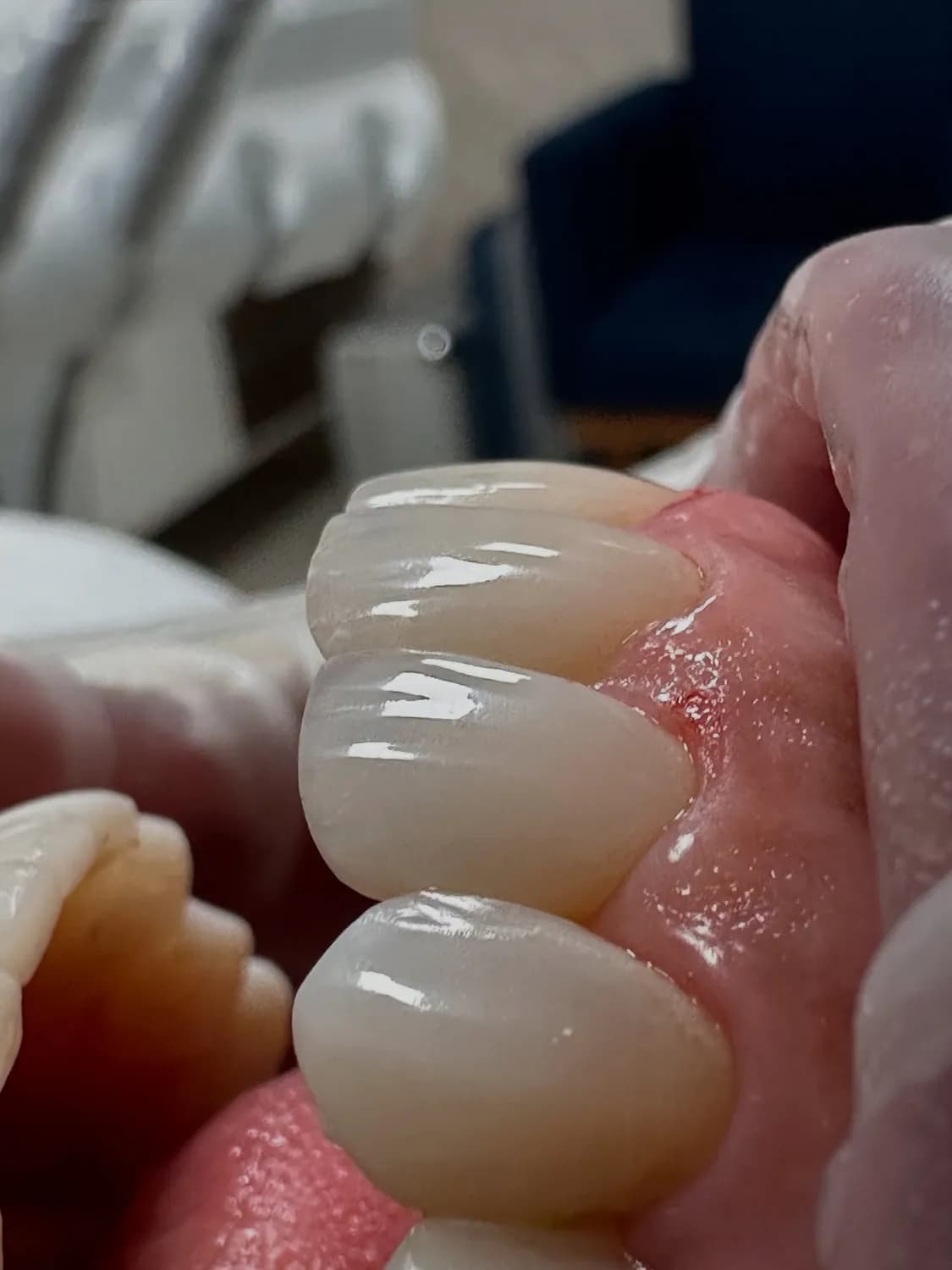 Facetas dentárias em cerâmica