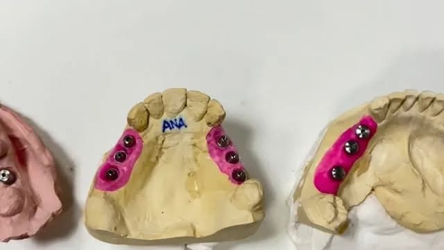 Modelos de gesso de reabilitação oral sobre implantes