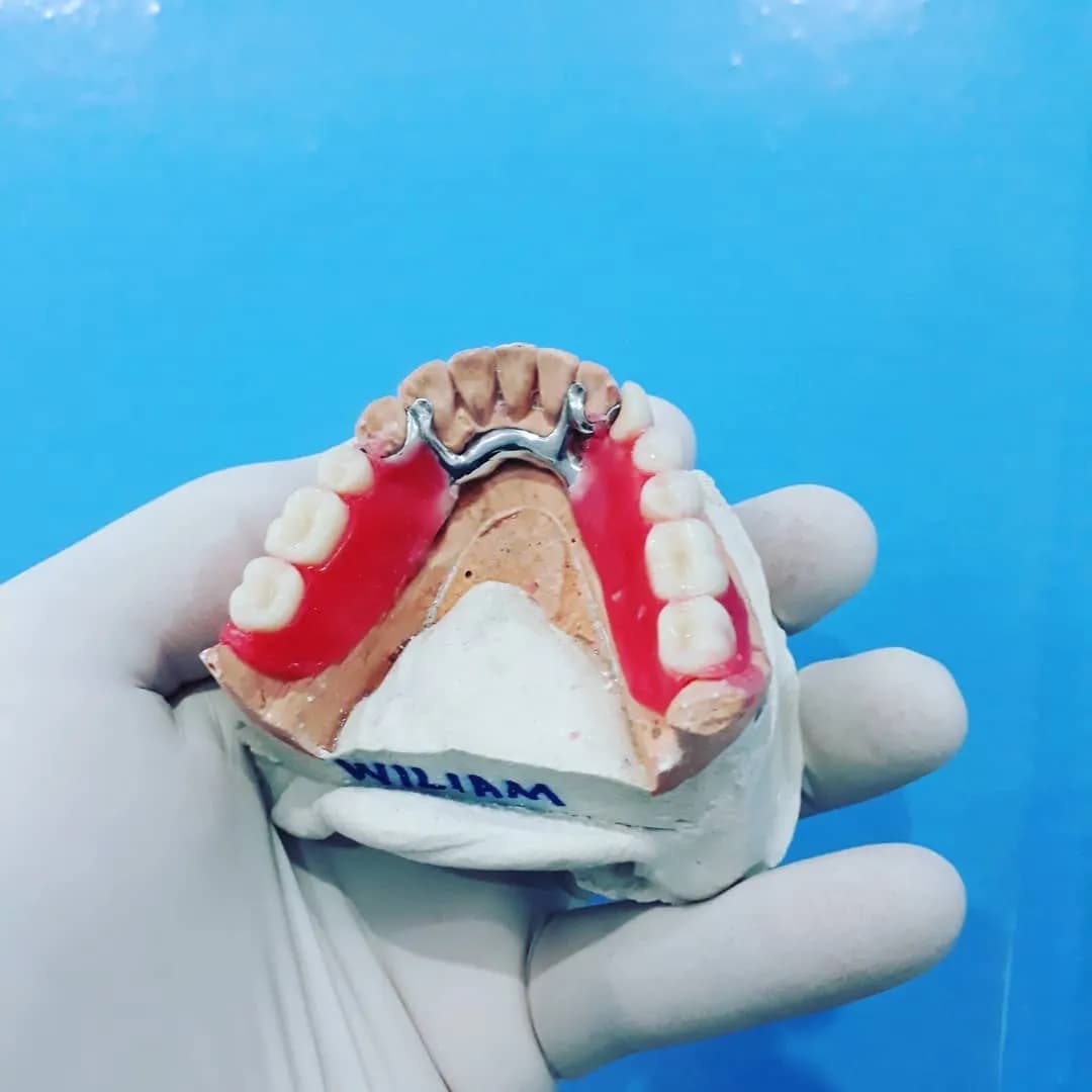 Prótese parcial com estrutura metálica