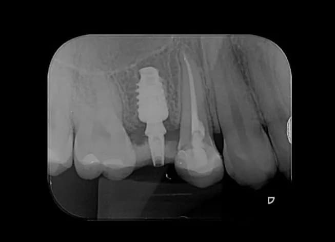 Radiografia de implante dentário
