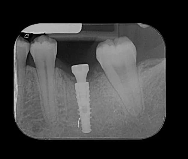 Radiografia de implante dentário
