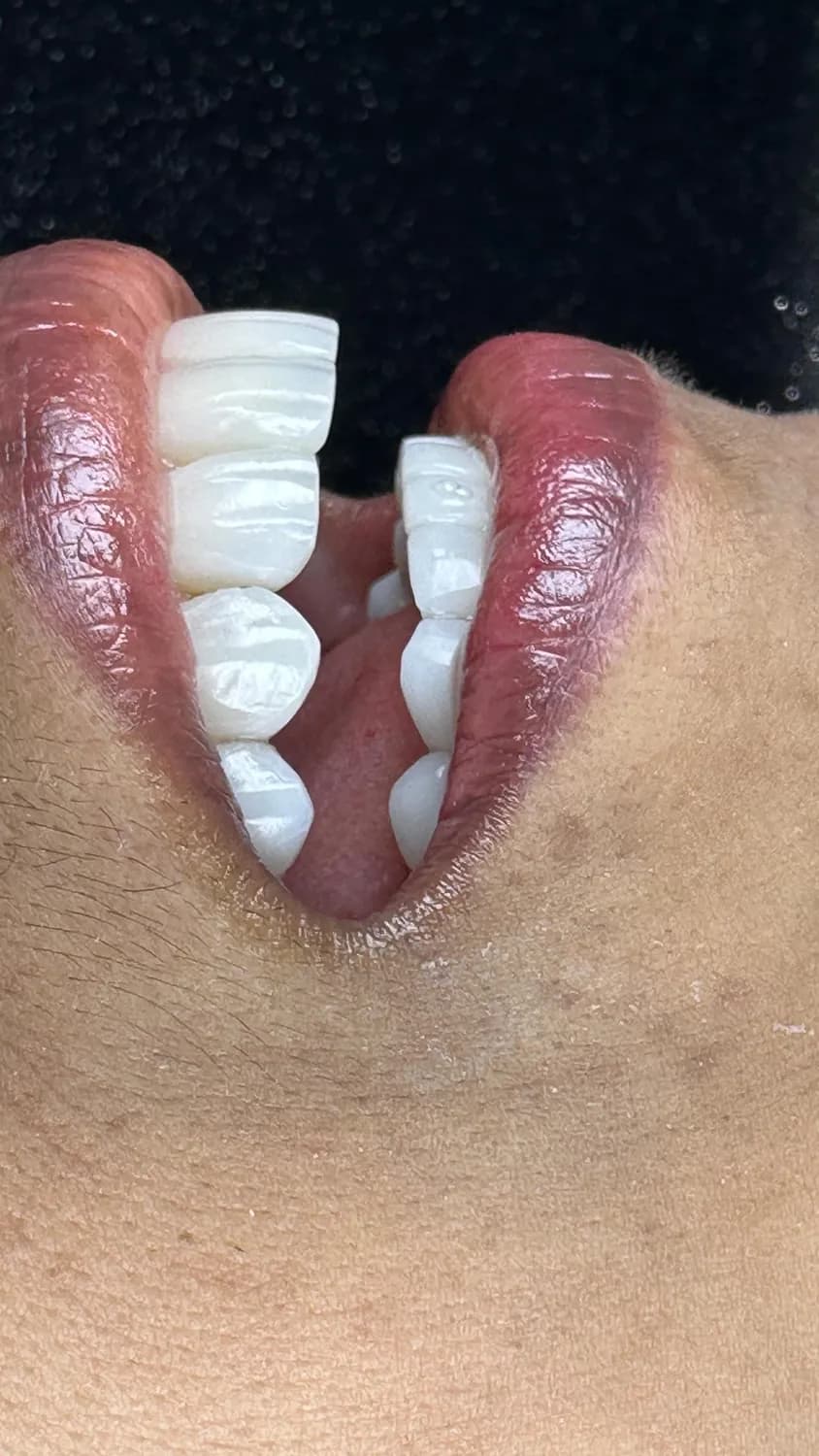 Facetas dentárias, vista frontal