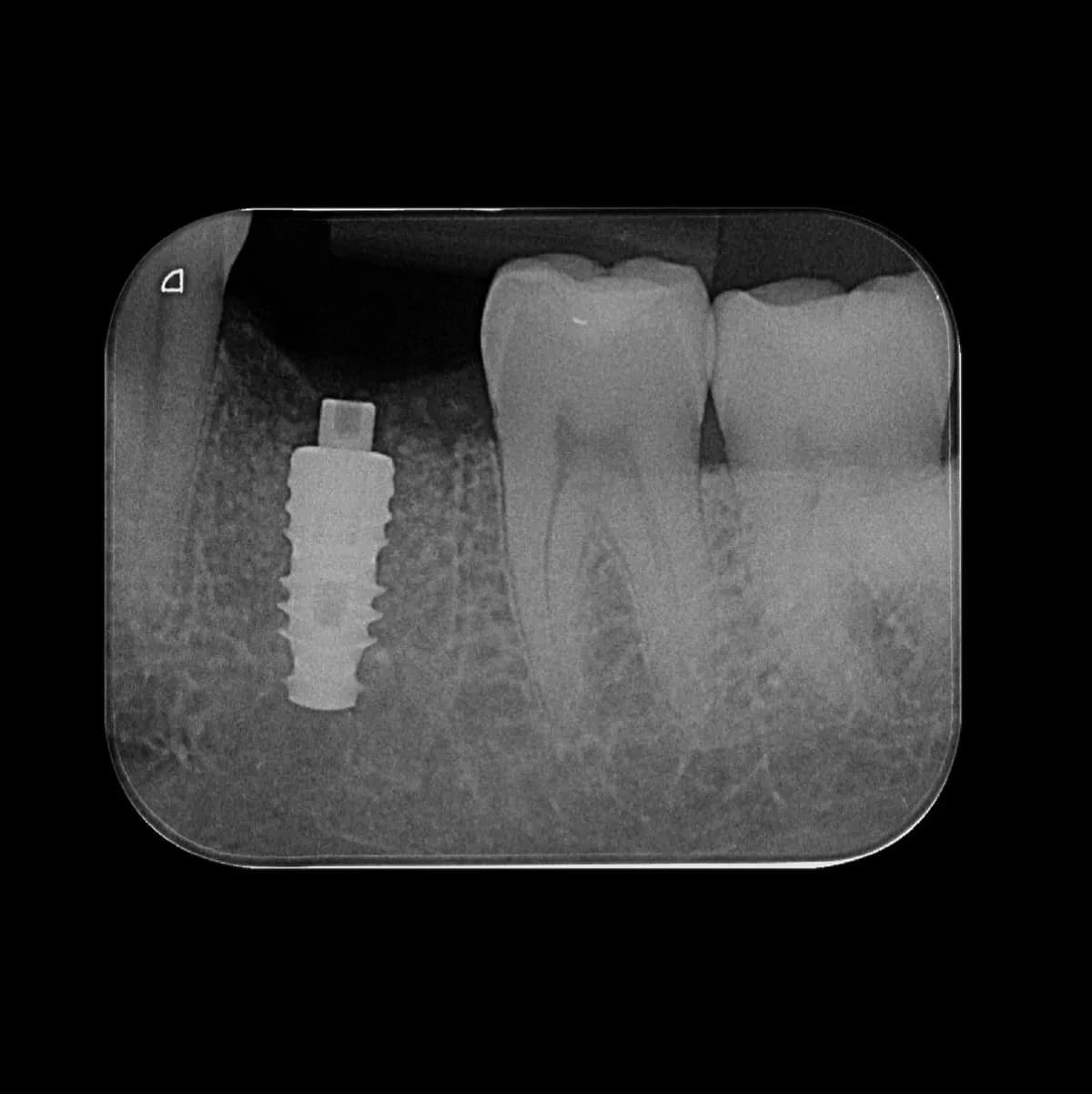 Radiografia de implante em região posterior