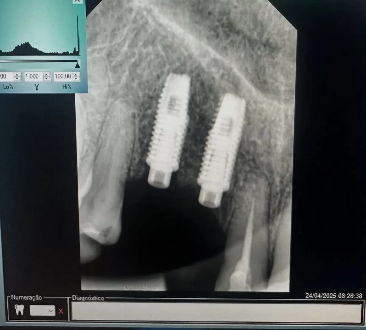 Radiografia de dois implantes dentários